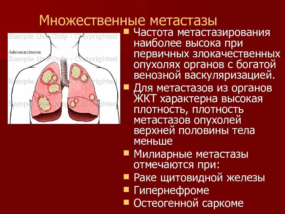 Метастатические опухоли легких. Легкое метастазирование. Прогноз жизни при метастазах