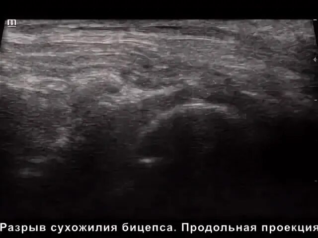 Разрыв бицепса мкб. Разрыв сухожилия бицепса. разрыв бицепса на узи. разрыв сухожилия бицепса узи. кальциноз сухожилия бицепса.