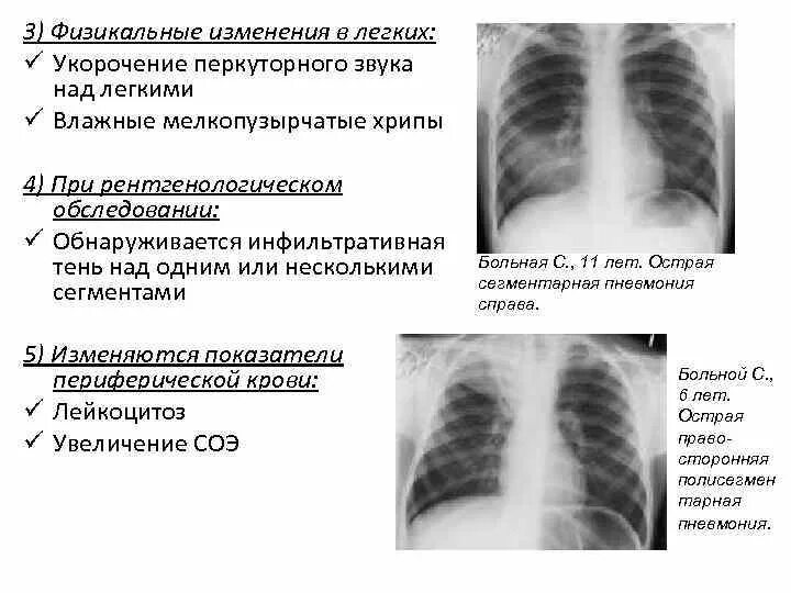 Хрипы при выдохе без кашля. Хрипы в легких при дыхании. при вдохе звук в легких. звуки в легких при пневмонии у детей. хрипы в лёгких у ребенка.