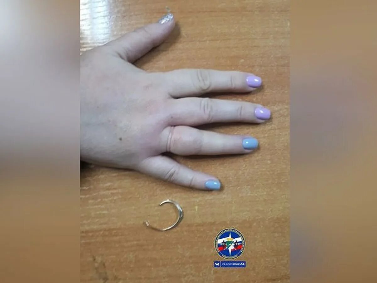 Опух палец где кольцо. Снять кольцо с опухшего пальца. кольцо впилось в палец.