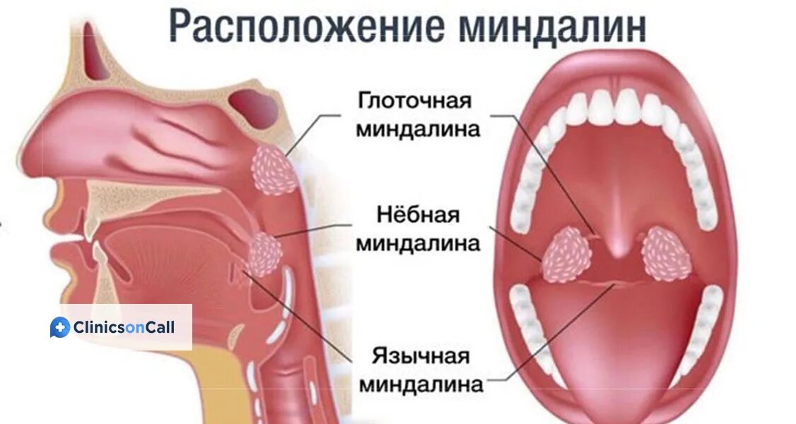 Как выглядит рак миндалин Вирусная ангина: симптомы и признаки, как выглядит горло, как отличить от бактер