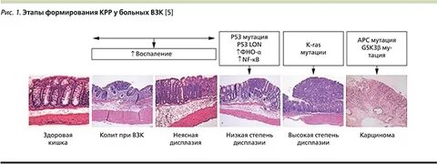Аденокарцинома кишки low grade g2