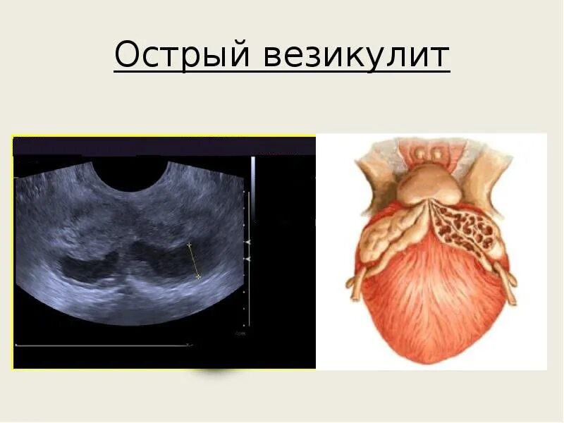 Везикулит симптомы и лечение у мужчин. УЗИ семенных пузырьков везикулит. Везикулит — воспаление семенных пузырьков. Что такое везикулит предстательной железы. Воспаление семенных пузырьков на УЗИ.