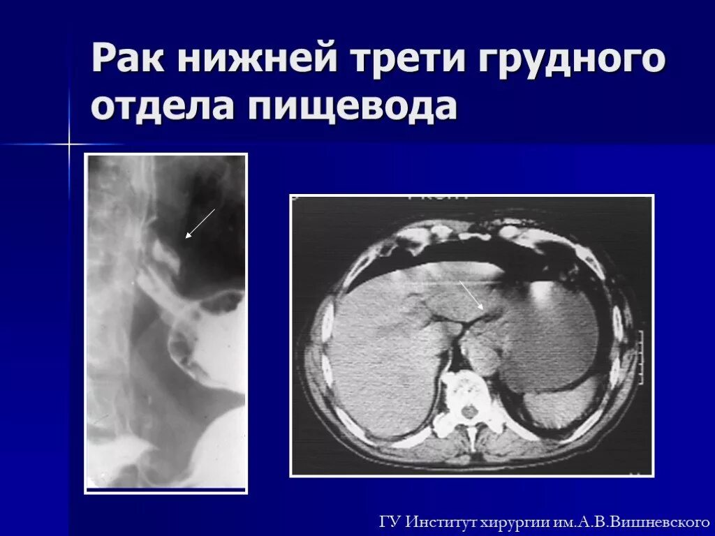 Хондрома позвоночника. Онкология грудного отдела. Объемное образование позвоночника. Интрамедуллярные опухоли спинного мозга ,снимок мрт. Гемангиома позвоночника th12 , l1.