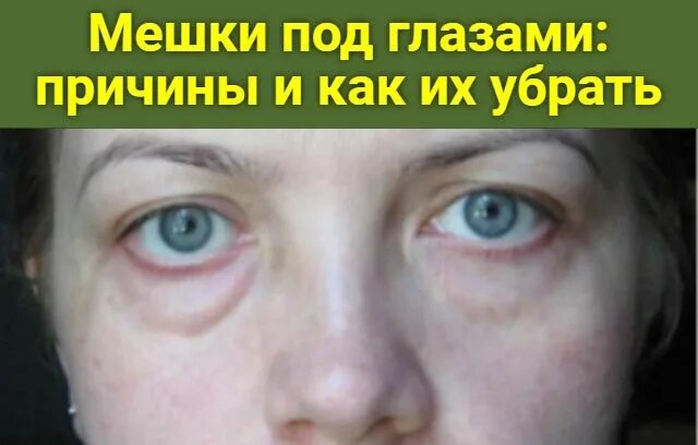 Как быстро убрать отек под глазами утром