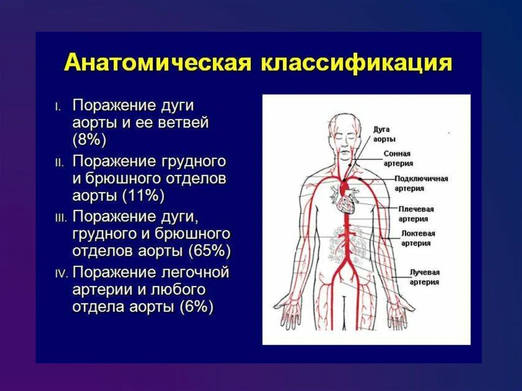 Грудной отдел аорты. Синдром такаясу классификация. аорта ее отделы и ветви. поражение ветвей дуги аорты. проекция аорты.