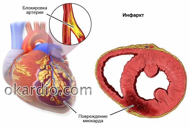Инфаркт миокарда микро. Симптомы микроинфаркта у женщин