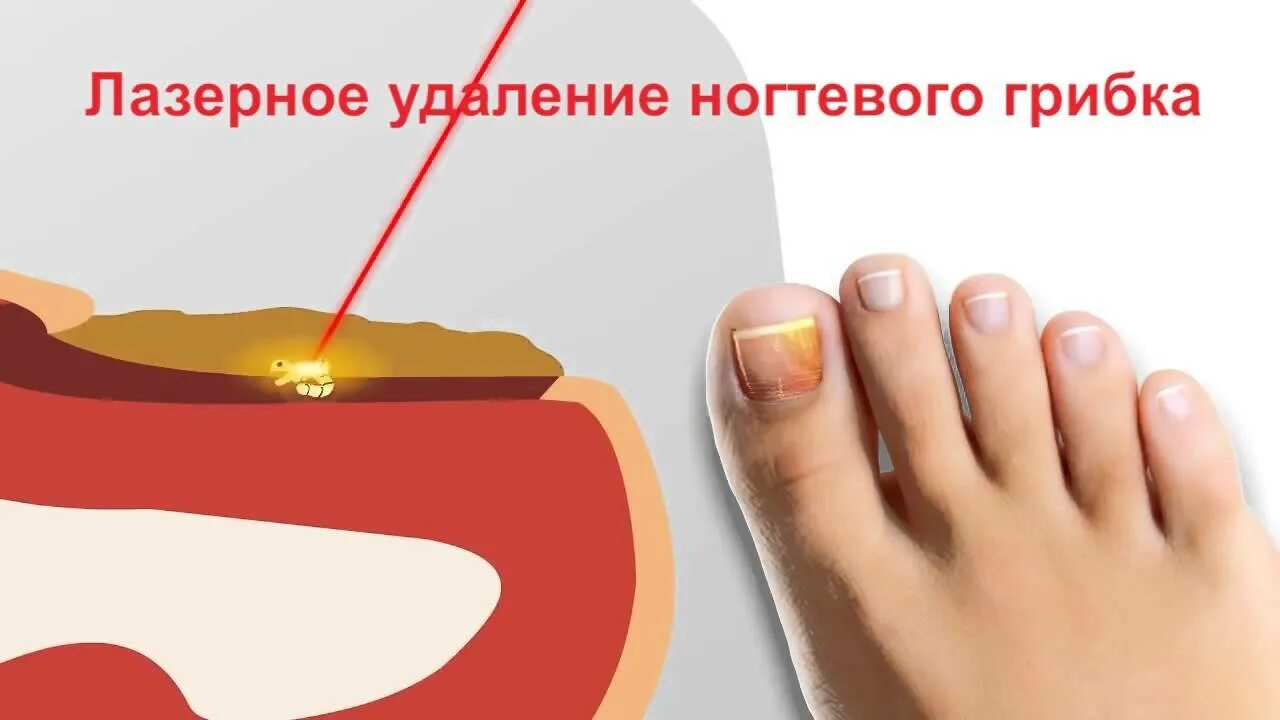 Лечение грибка ногтя врач. Лазерная терапия грибка ногтей. Обработка грибковых ногтей.