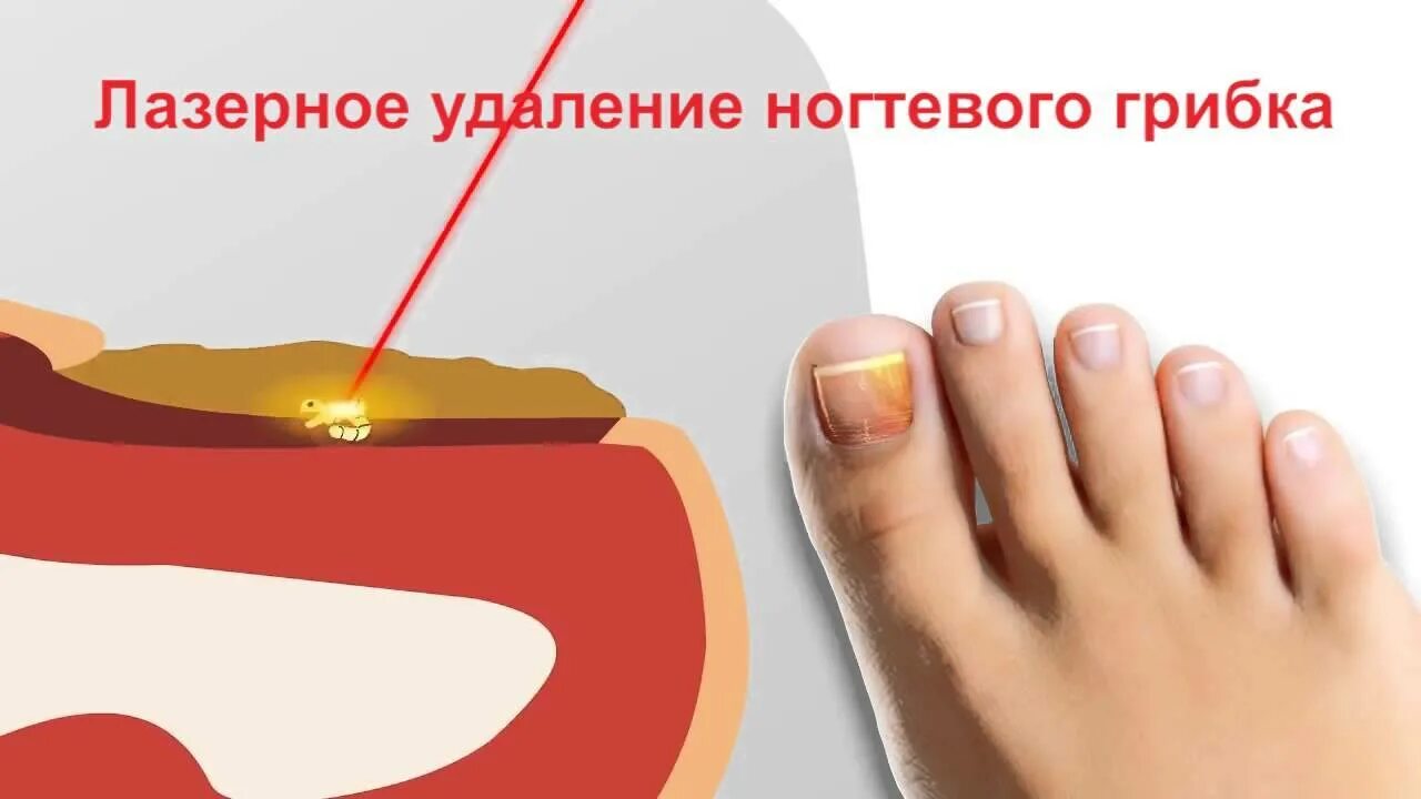 Лечение грибка на ногах лазером отзывы. Лазерная терапия грибка ногтей. обработка грибковых ногтей.