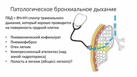 Бронхиальное дыхание причины