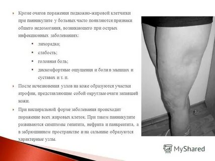 Болезнь вебера крисчена