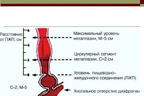 Симптомы барретты