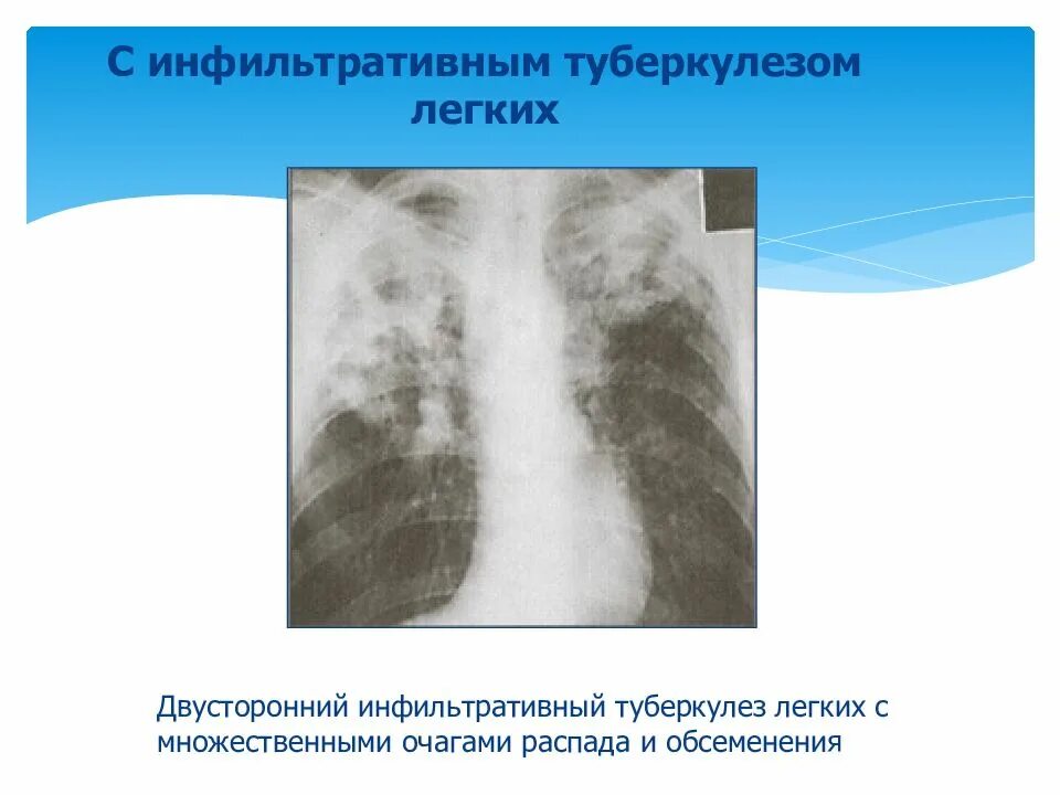 Инфильтративный распад легких