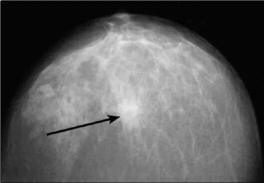 Маммография уплотнения. Узловая мастопатия молочной железы маммография. Фибролипома молочной железы рентген. Фиброзная мастопатия маммограмма. Фиброаденома молочной железы маммограмма.