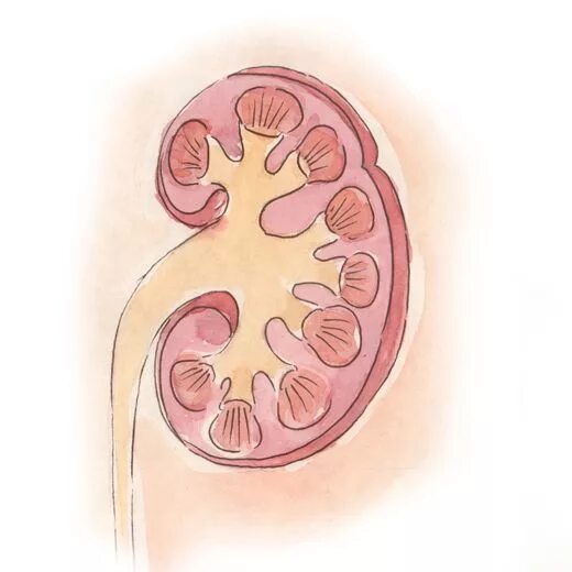 Почечная лоханка рисунок. Расширение лоханки гидронефроз. Гидронефроз чашечно лоханочной системы. Калькулезный гидронефроз. Камни почки и гидронефроз.