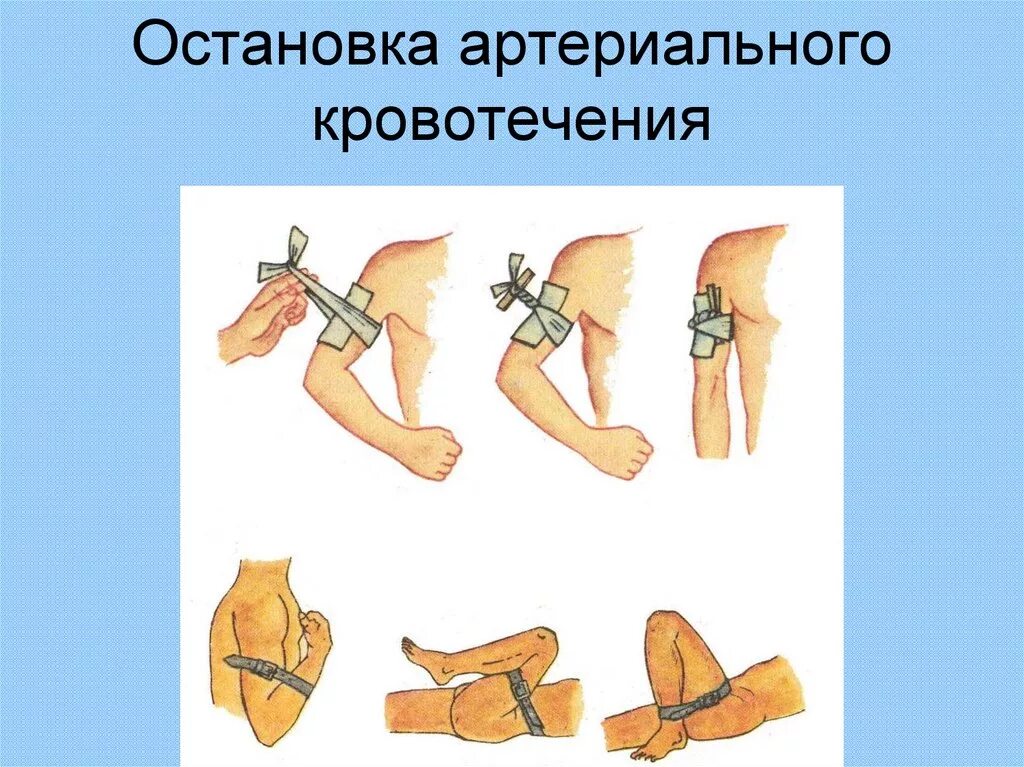 Пути остановки кровотечений. Остановка артериального кровотечения алгоритм. Алгоритм при остановке артериального кровотечения. Остановка артериального кровотечения кровотечения алгоритм. 1. Способ остановки артериального кровотечения алгоритм.
