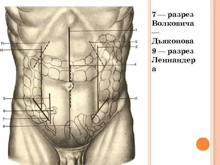 Аппендэктомия разрез по Волковичу Дьяконову. Разрез Мак Бурнея Волковича Дьяконова. Лапаротомия брюшной полости. Разрез Волковича-Дьяконова. Толстая брюшная стенка