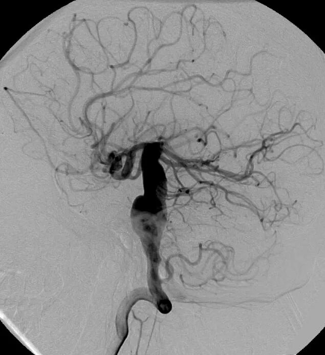 Ангиограмма аневризма. Ангиография головного мозга аневризма. Аневризма артерии головного мозга. Церебральная ангиограмма аневризма.