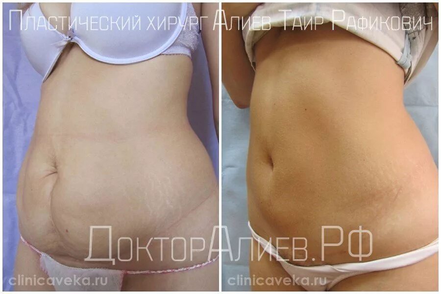 фото по Абдоминопластике (пластика живота)