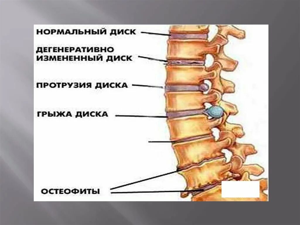 Спинные диски. Грыжа протрузия позвоночника. Протрузия диска позвоночника. Выпячивание межпозвоночного диска.