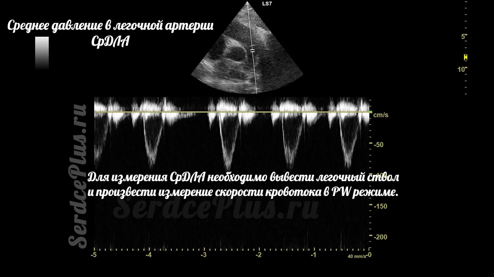 Измерение давления в легочной артерии при ЭХОКГ. Эхокардиография среднее давление в легочной артерии по ЭХОКГ. Давление в легочной артерии по ЭХОКГ. Среднее давление в легочной артерии по ЭХОКГ. Легочная гипертензия сдла