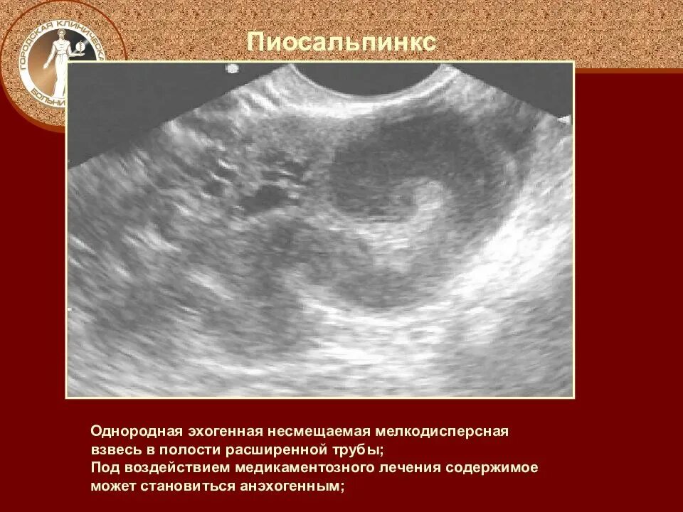 Мелкодисперсная гиперэхогенная взвесь. Левосторонний пиосальпинкс.