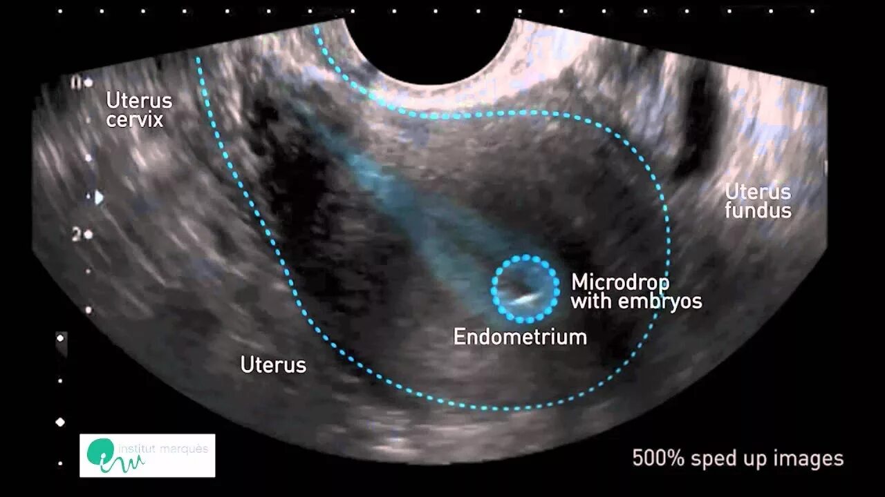 Эмбрион в матке после переноса. УЗИ после переноса эмбрионов. Матка после подсадки эмбрионов.