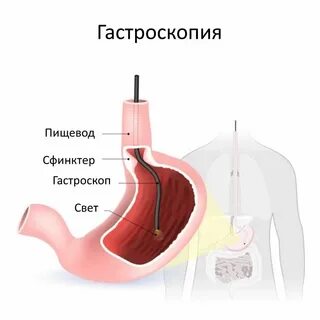 Что такое эзофагогастродуоденоскопия и как ее делают