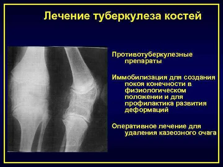 Костно-суставной туберкулез стадии. Костно-суставной туберкулез осложнения. Костно-суставной туберкулез формы. Туберкулез костно суставной системы.