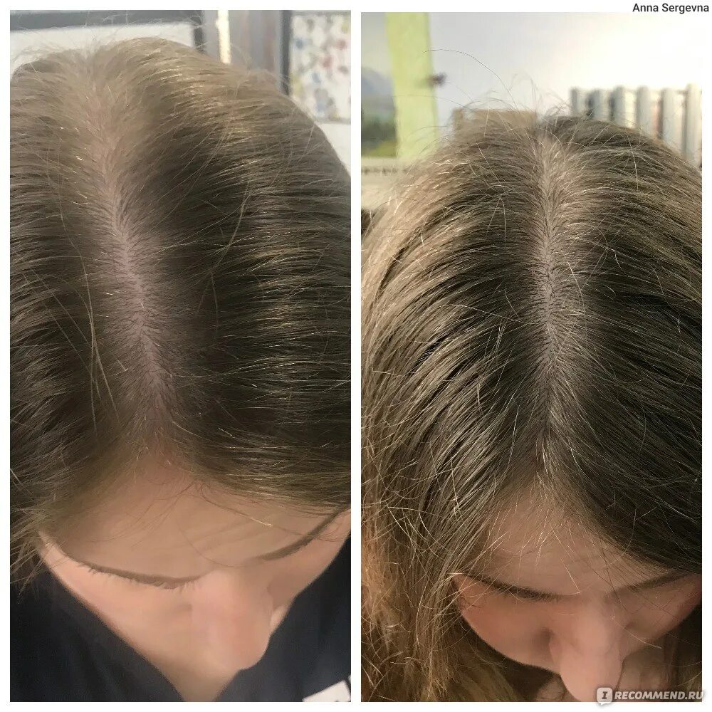 Нормальная густота волос у женщин. Волосы средней густоты у женщин. Пробор волос до и после.