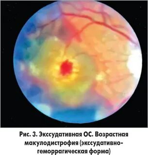 Отслойка сетчатки причины и последствия