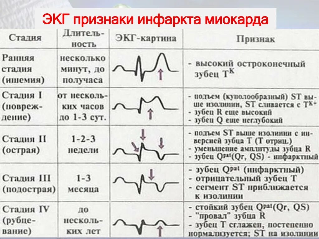 St ишемия. Стадии трансмурального инфаркта миокарда на ЭКГ. Трансмуральный инфаркт на ЭКГ признаки. Острая стадия трансмурального инфаркта миокарда ЭКГ. Отрицательный зубец р после QRS комплекса.