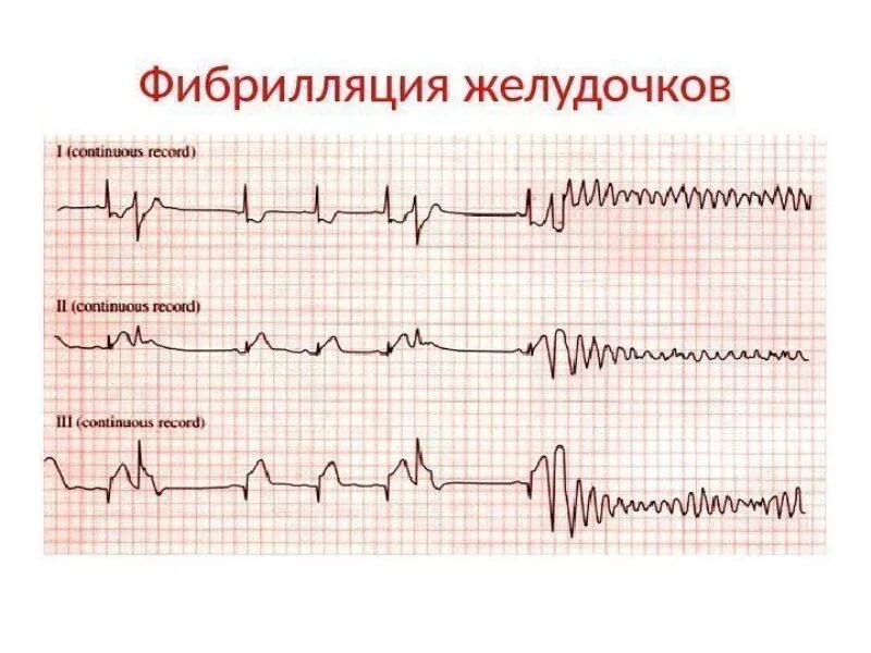 Фибрилляция мышц. Кардиограмма фибрилляция желудочков. экг при фибрилляции желудочков. мелковолновая фибрилляция желудочков экг. экг картина трепетания желудочков.