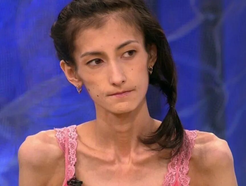 Покажите самых худых. Самый худой человек в мире лючия. Самый худой человек в мире лючия сарате. Джоди кидд анорексия. Покажите самых худых.