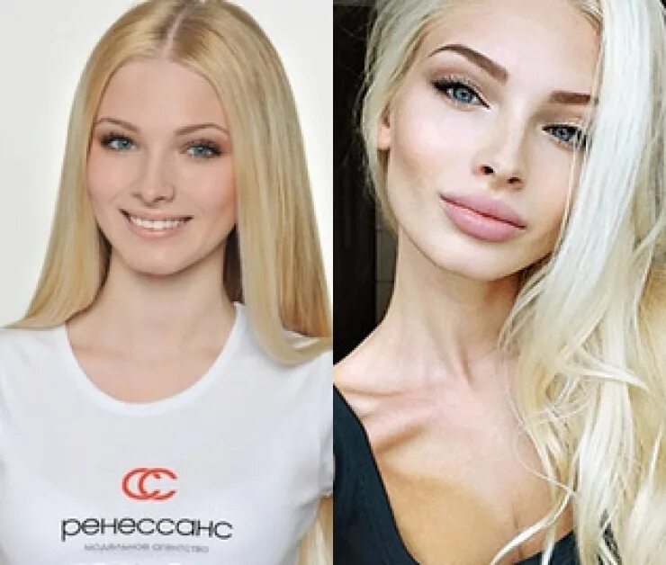 Alena Shishkova before and after plastic surgery Plastic surgery, Celebrity plas