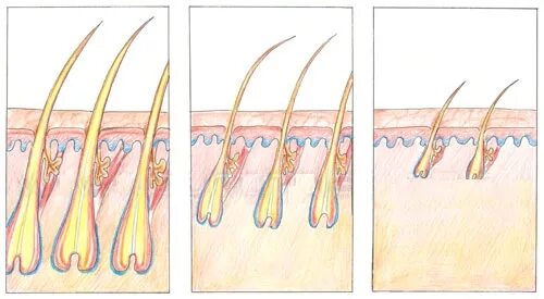 Растут корни волос. Алопеция волосяной фолликул. Волосяные луковицы на голове. Волос с волосяной луковицей. Луковица волоса.