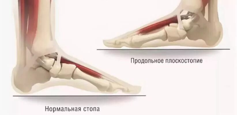 Продольное поперечное и комбинированное плоскостопие. Продольное плоскостопие 3 степени армия. Продольно-поперечное плоскостопие степени. Степени продольного и поперечного плоскостопия.