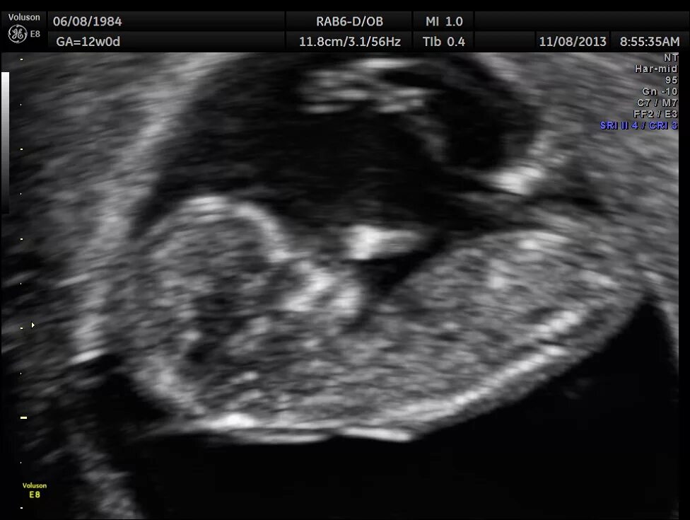 УЗИ 12-13 недель беременности. Снимок УЗИ 13 недель. Узии на 13 неделе беременности. 13 неделя коричневые
