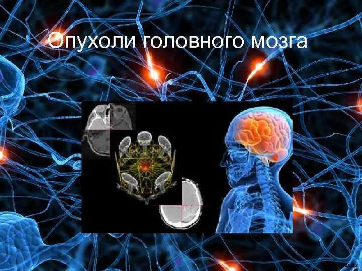 Опухоли головного мозга презентация. Презентация опухоль мозга. Опухоли головного мозга през. Опухоли мозга неврология