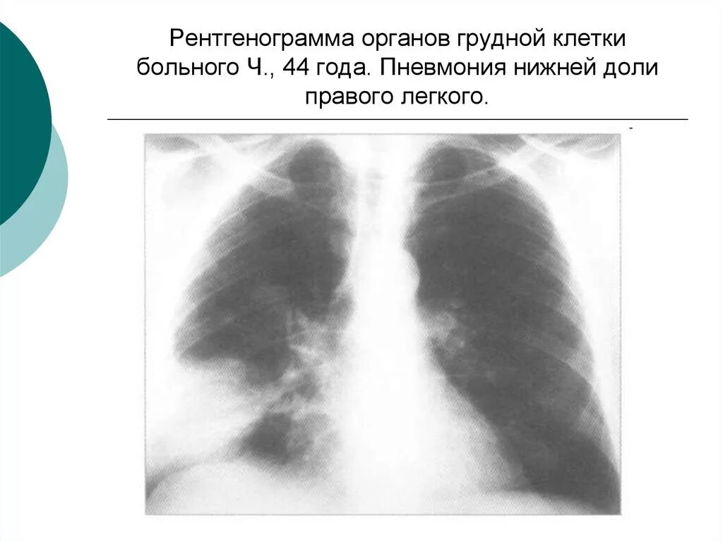 Полисегментарная пневмония снимки. Крупозная пневмония рентген. Рентгенография грудной клетки пневмония. Рентген органов грудной клетки пневмония. Пневмония в нижней доле правого легкого