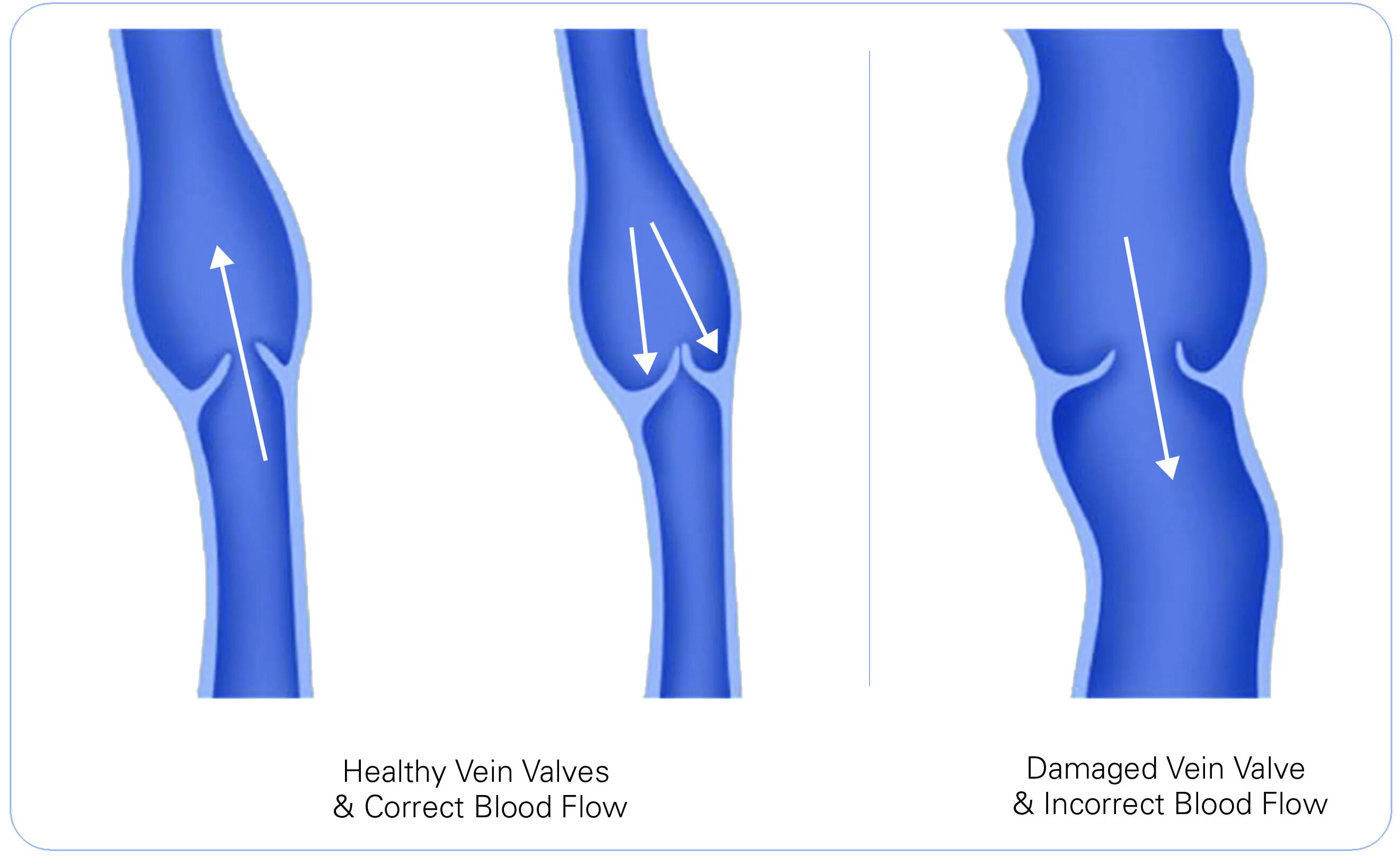 Вены ног клапаны. Варикозное расширение вен нижних конечностей этиология. Варикозное расширение вен клапаны. Варикозное расширение вен клапаны нижних. Рефлюкс вен нижних конечностей.