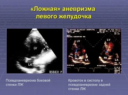 Нарушение в левом желудочке