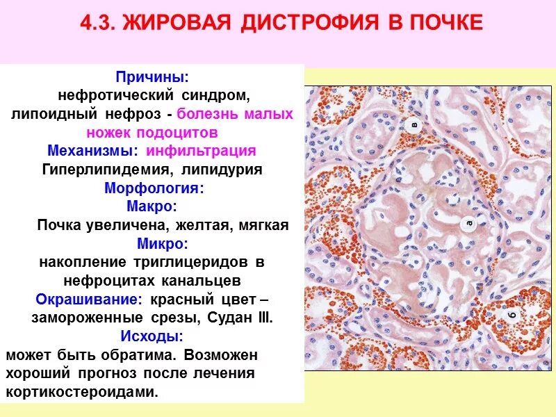 Дистрофия латынь. Жировая дистрофия почек макропрепарат. Гидропический нефроз патанатомия. Жировая дистрофия эпителия канальцев почек. Паренхиматозная жировая дистрофия печени патологическая анатомия.