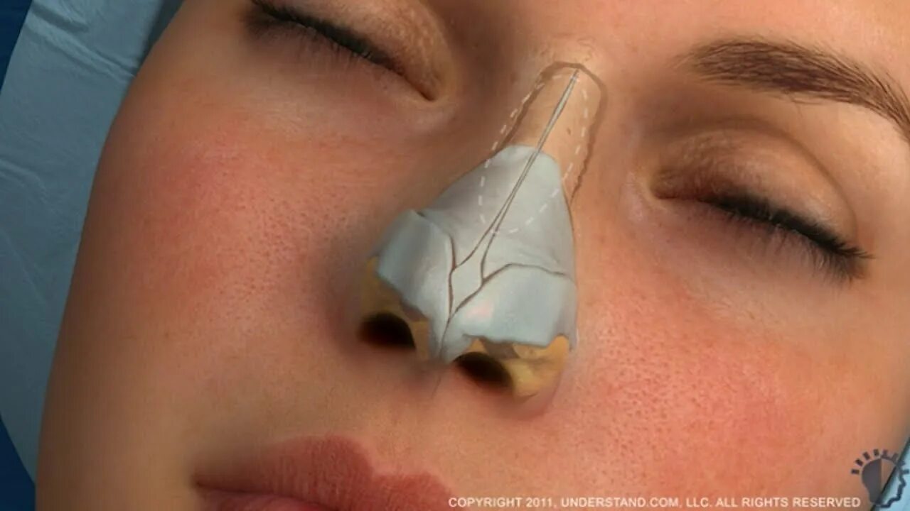 Септопластика носовой перегородки операция. Пластика перегородки носа. Сплинты для носовой перегородки. Тампоны в нос после операции