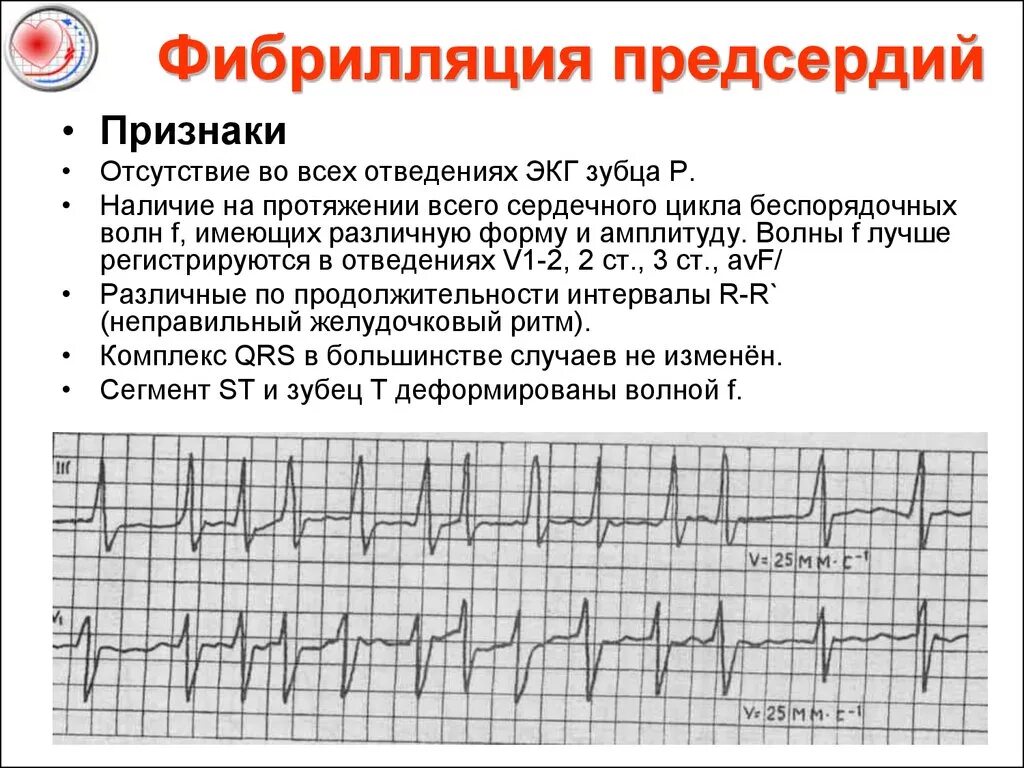 Фибрилляция предсердий на ЭКГ признаки. Фибрилляция и трепетание предсердий на ЭКГ. Пароксизмальная форма фибрилляции предсердий ЭКГ. ЭКГ при фибрилляции предсердий тахисистолическая форма.