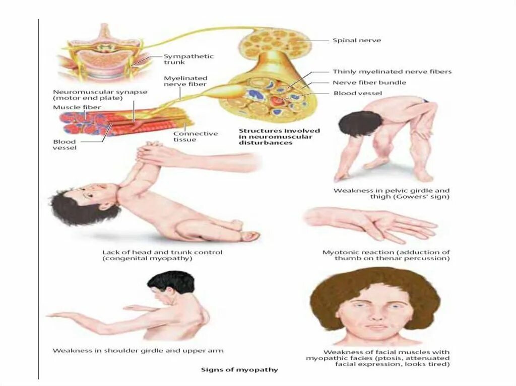Нервно мышечные патологии. Нервно-мышечные заболевания. Нейромышечные заболевания. Нервно-мышечные нарушения.. Первичное поражение мышц.