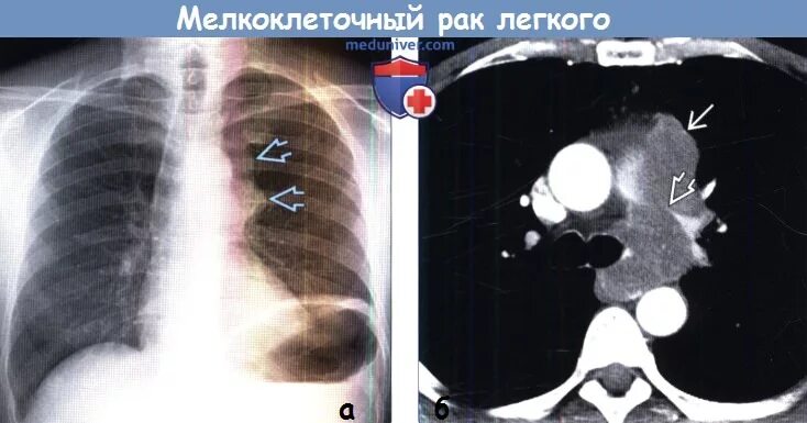 Рак легких на кт как выглядит фото Комплексная лучевая диагностика периферического рака легкого. Курсовая работа (т