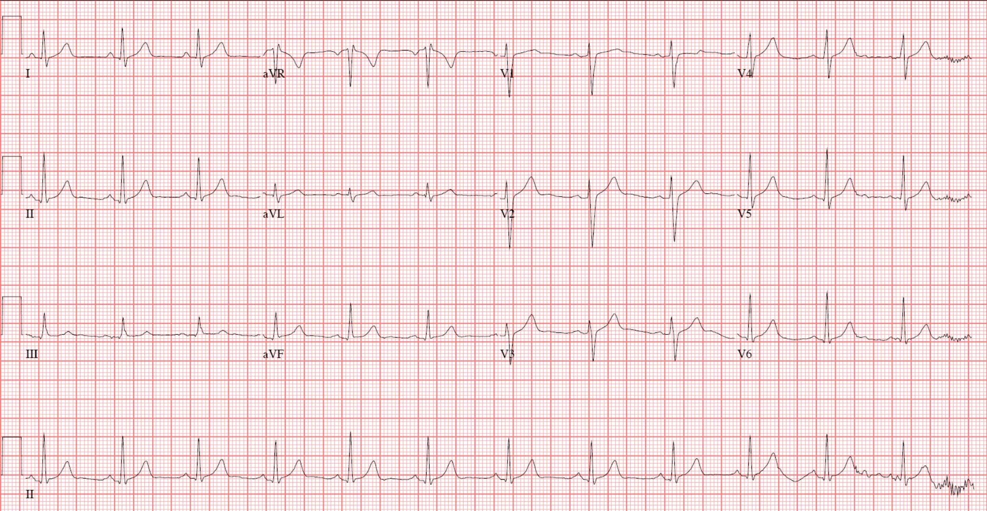 Нормальная экг в 12 отведениях. Екк. Экг ставрополь. Normal 12 lead ecg. Суточный мониторинг экг.