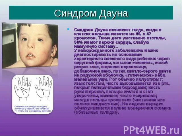 Дауна дают даунам дают инвалидность. Синдром дауна. наследственное заболевание человека синдром дауна.