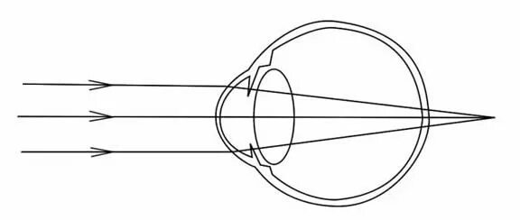 Фокусировка глаза человека. Гиперметропия схема глаза. Дальнозоркость схема физика. Дальнозоркость схема глаза. Ход лучей близорукость и дальнозоркость.